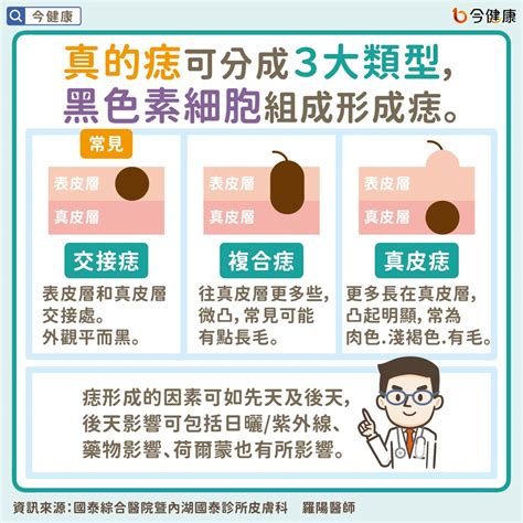 紅色痣代表什麼|是痣？皮膚癌？還是什麼？常見Q&A解惑！醫教揪出「。